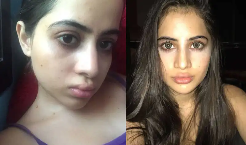 ‘My lips were too thin’: Uorfi Javed reveals her horrific experience with lip fillers, shares never-seen-before selfies