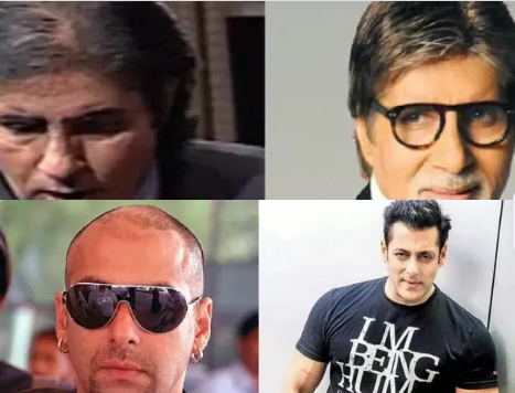 13 Bollywood & Hollywood Actors Who've Undergone Hair Transplant Surgery 